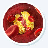 High Cholesterol